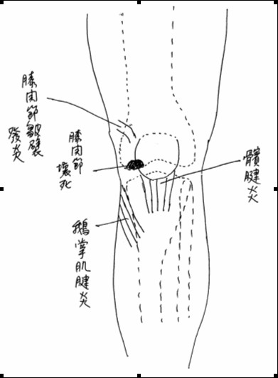 小心! 膝蓋痛不等於退化性關節炎，正確診斷，才能把握治療良機(相關圖片)