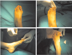 常見的足部及踝關節問題之最新治療趨勢與微創性手術(相關圖片)