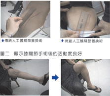微創型人工膝關節與髖關節置換手術 (相關圖片)