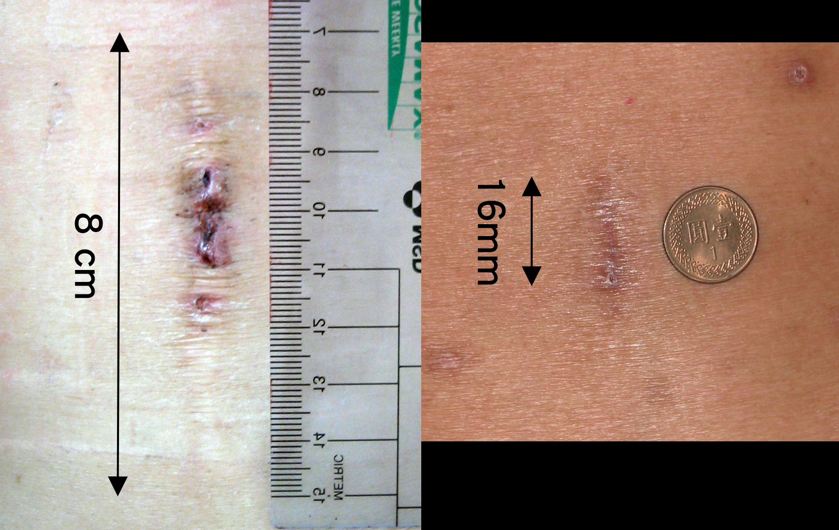 微創脊椎內視鏡手術新趨勢(相關圖片)