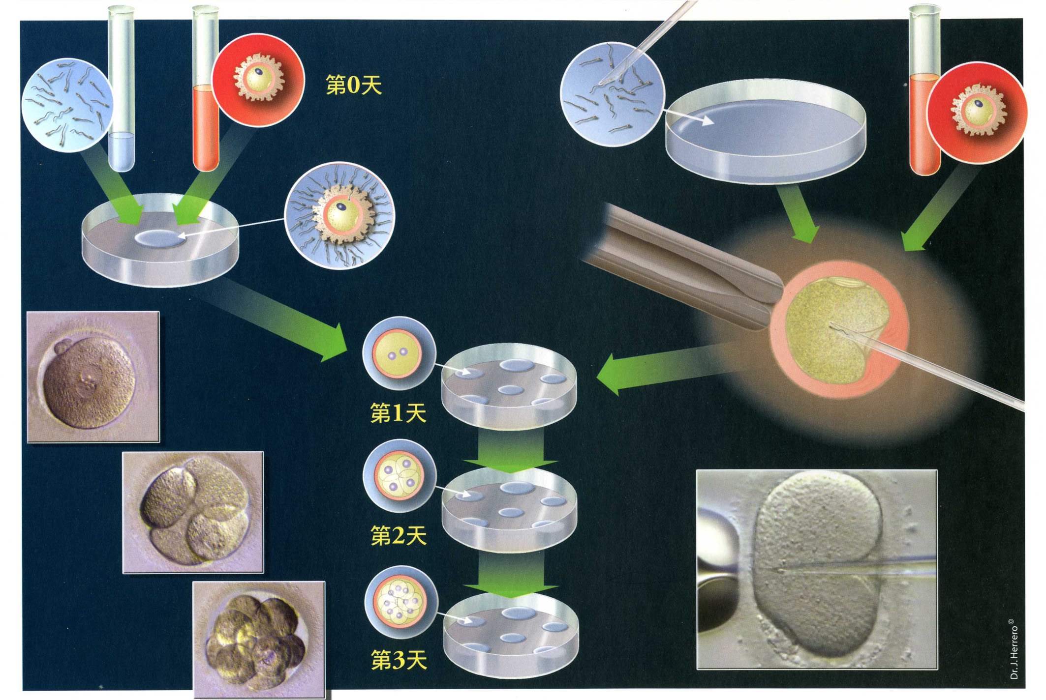 不孕症治療;送子鳥報到(相關圖片)
