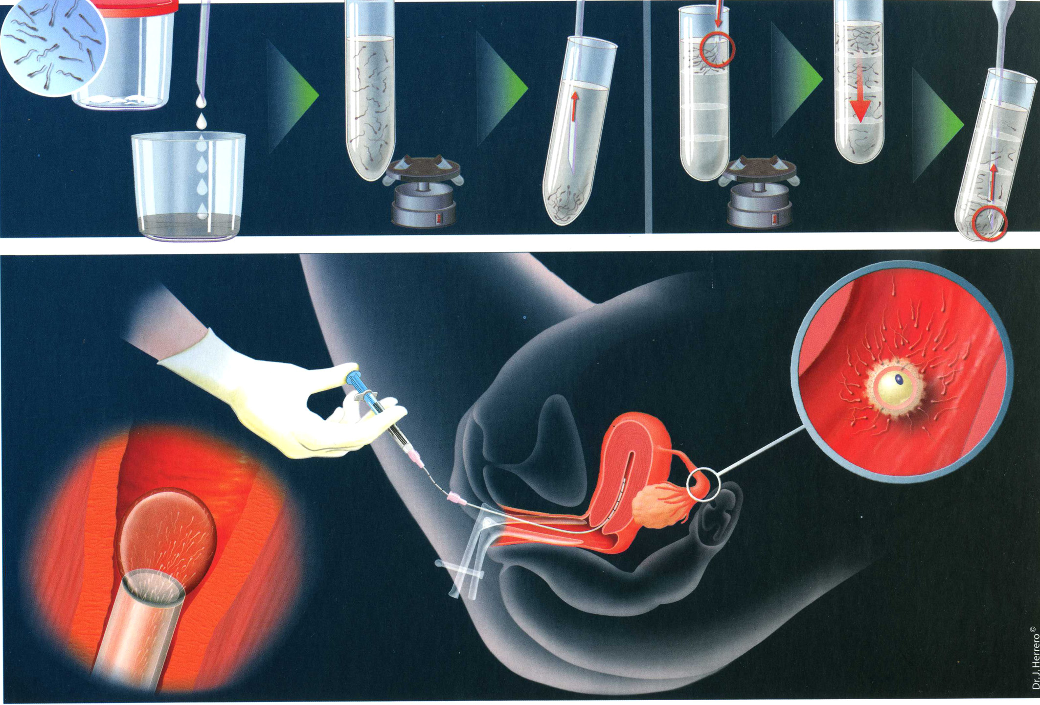 不孕症治療;送子鳥報到(相關圖片)