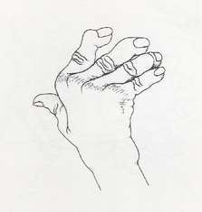 類風濕性關節炎與復健(相關圖片)