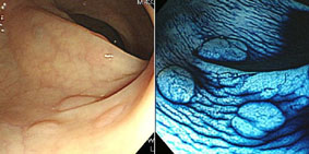 最新的內視鏡科技：找出感覺不到的早期腫瘤(相關圖片)