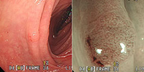 最新的內視鏡科技：找出感覺不到的早期腫瘤(相關圖片)