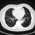 低輻射劑量肺部電腦斷層掃描 Low-dose chest CT(相關圖片)
