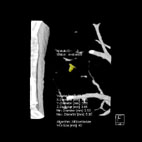 低輻射劑量肺部電腦斷層掃描 Low-dose chest CT(相關圖片)