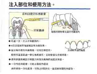 齒齦下抗生素製劑在牙周病輔助性療法之應用(相關圖片)