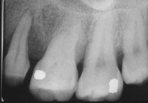 牙周再生治療新利器 (相關圖片)