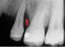 牙周再生治療新利器 (相關圖片)