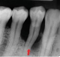 牙周再生治療新利器 (相關圖片)