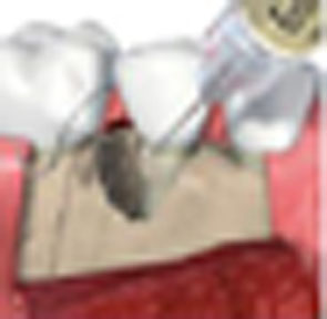 牙周再生治療新利器 (相關圖片)