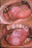 認識口腔癌及其癌前病變(相關圖片)