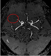腦中風的預防與健康檢查(相關圖片)