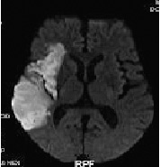 腦中風的預防與健康檢查(相關圖片)
