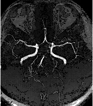 腦中風的預防與健康檢查(相關圖片)