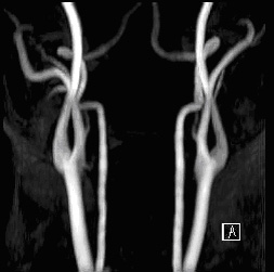 腦中風的預防與健康檢查(相關圖片)