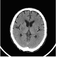 腦中風如何治療？(相關圖片)