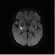 腦中風如何治療？(相關圖片)