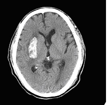 腦中風如何治療？(相關圖片)