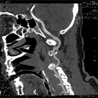    天氣冷颼颼，預防腦中風的發生(相關圖片)