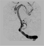    天氣冷颼颼，預防腦中風的發生(相關圖片)