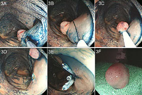 健康檢查的胃鏡與大腸鏡 —最新內視鏡科技的性能展示(相關圖片)