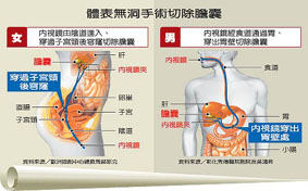 經自然孔道內視鏡手術(相關圖片)