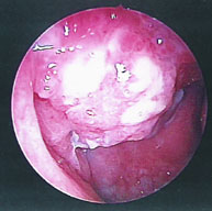 耳鼻喉科軟組織超音波檢查---評估頭頸部原因不明腫塊的利器  (相關圖片)