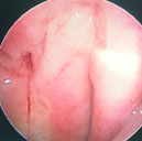 耳鼻喉科軟組織超音波檢查---評估頭頸部原因不明腫塊的利器  (相關圖片)