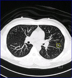 肺癌不是抽菸者的專利，提早透視您的肺!低劑量肺部電腦斷層掃描 Low-dose chest CT(相關圖片)