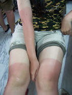 靠近陽光 遠離曬傷(相關圖片)