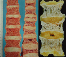 老人骨鬆，慎防跌倒(相關圖片)