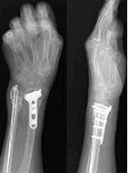 老人骨鬆，慎防跌倒(相關圖片)