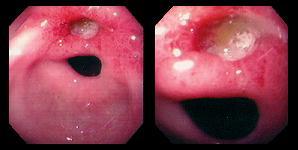 幽門桿菌與消化性潰瘍之關係(相關圖片)