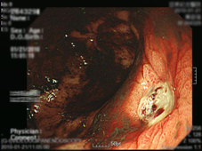 幽門桿菌與消化性潰瘍之關係(相關圖片)