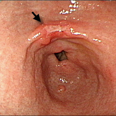 胃癌的基本認識(相關圖片)