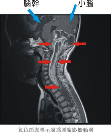 全癱幼兒經導航螺旋刀治療後重獲新生(相關圖片)