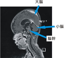 全癱幼兒經導航螺旋刀治療後重獲新生(相關圖片)