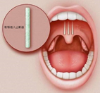 鼾聲如雷  打鼾、呼吸中止症治療新進展『軟顎植入止鼾器』(相關圖片)