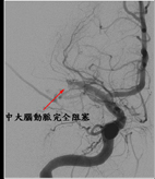 顱內支架搶救小兒中風(相關圖片)