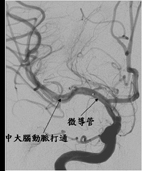 顱內支架搶救小兒中風(相關圖片)