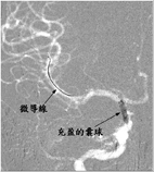 顱內支架搶救小兒中風(相關圖片)