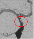 顱內支架搶救小兒中風(相關圖片)