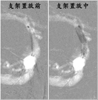 顱內支架搶救小兒中風(相關圖片)