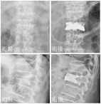骨質疏鬆症與脊椎壓迫性骨折    先進骨科手術介紹─經皮椎體成形術(相關圖片)