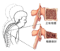 骨質疏鬆症與脊椎壓迫性骨折    先進骨科手術介紹─經皮椎體成形術(相關圖片)