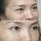 微整形化妝術   談玻尿酸美顏保養(相關圖片)