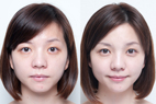 微整形化妝術   談玻尿酸美顏保養(相關圖片)