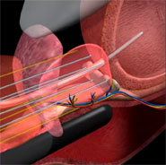 淺談前列腺(攝護腺)癌之新療法    氬氦刀冷凍治療手術(相關圖片)